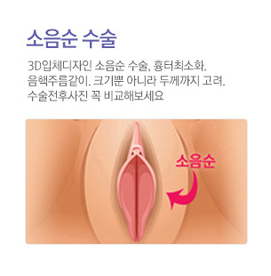 소음순수술