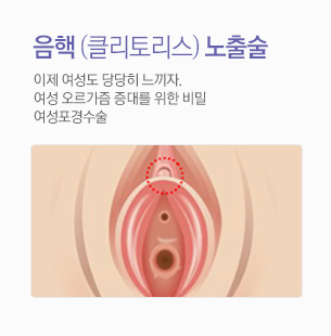 음핵노출술