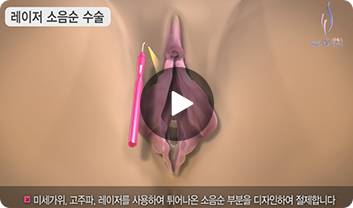 소음순수술