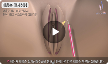 대음순수술