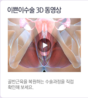 이쁜이수술3d동영상