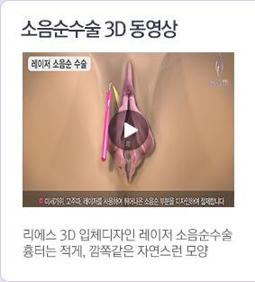 소음순수술3d동영상