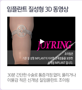 임플란트질성형3d동영상